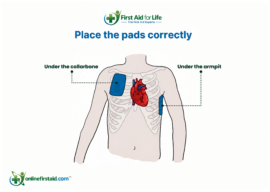 AED pad placement - men