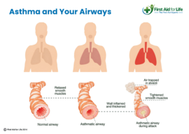 Asthma and Your Airways